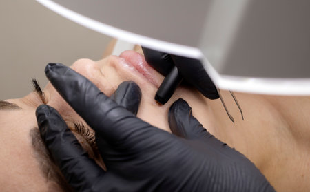 Dermatologist Removes Hair Above Lips On Womans Face With Electrolysis. Electric Epilation In Beauty Salon, Unrecognized Patient. Horizontal Plane. Authentic Photoの写真素材