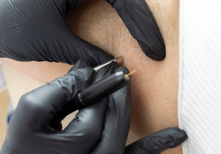 Closeup Dermatologist Pulling Hair On Patients Underarm With Tweezers, Electrolysis Procedure, Electric Epilation In Beauty Salon. Hair Removal Treatment. Horizontal Planeの写真素材