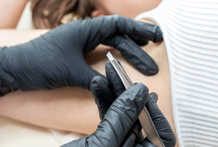 Closeup Dermatologist Holds Removed Hair With Tweezers Above Patients Underarm, Electrolysis...