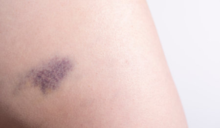 Closeup Blue Purple Hematoma, Bruise On Thigh, Hip After Trauma, Fall. Horizontal plane. Clotted...