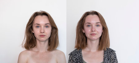 Before and After Mesotherapy And Microneedling Treatment. Portrait Of Real Female Patient After Beauty Invasive Cosmetic Procedure Using Thin Needles. Microdermabrasion, Horizontal Planeの写真素材