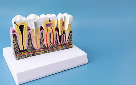 Dental Tooth Bridge Or Implant Model On Blue Background, Copy Space For Text. Dummy Mockup Human Jaw Oral Dentures. Prosthesis On Metal Peg. Horizontal Planeの写真素材