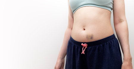 Female Person Belly And Hands With Hematoma, Bruise After Injection, Blood Sampling On White Background. Injury, Post-injection phlebitis. Copy Space For Text. Horizontal plane. Mockupの写真素材