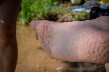 Close up on the sole of a human foot showing severely wrinkled skin and inflammation outdoors in a...
