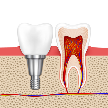 Healthy teeth and dental implant. Implant tooth, health tooth medical dentistry, vector illustrationのイラスト素材