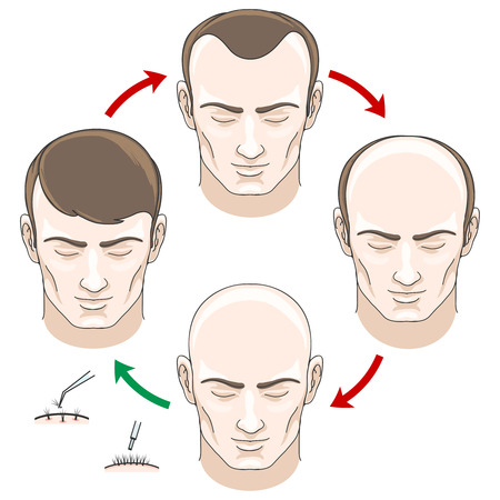 Stages Of Hair Loss Hair Treatment And Hair Transplantation Hair
