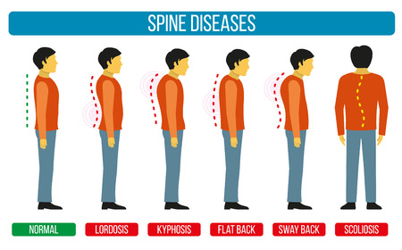 Body posture defect. Vector infographics of spine diseases. Scoliosis and lordosis medical diagrams. Spine backbone, spine diagnosis, diagnostic spine symptom, design spine diseases illustrationのイラスト素材