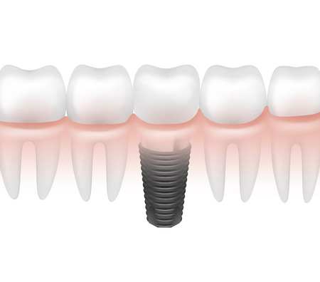 Vector metal dental implant between other teeth in gum side view isolated on white backgroundのイラスト素材