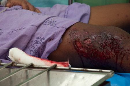 YALA, THAILAND - FEBUARY 23: Soldier's Leg wound from time bomb explode on bed in emergency room on Feb 23, 2012 at Yaha Hospital Yala, Thailandのeditorial素材