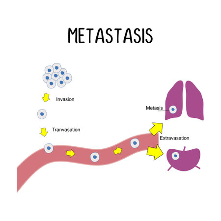 Metastasis: The spread of cancer cells from the original tumor to other parts of the body through the bloodstream or lymphatic system.のイラスト素材