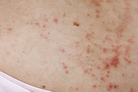 Skin disease prickly heat rash or miliaria on back skin of asian woman. Healthcare skin cause for outdoor work in sunny with hot weather and have sweat. Dermatologist and treatment medication concept.の写真素材
