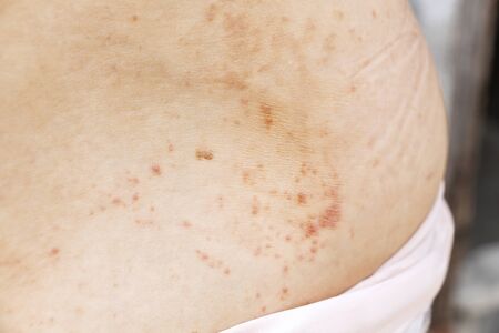 Skin disease prickly heat rash or miliaria on back skin of asian woman. Healthcare skin cause for outdoor work in sunny with hot weather and have sweat. Dermatologist and treatment medication concept.の写真素材