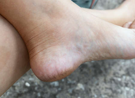 Cracked heels and foot with dry skin of woman from dirty. Concept treatment skin care foot and...