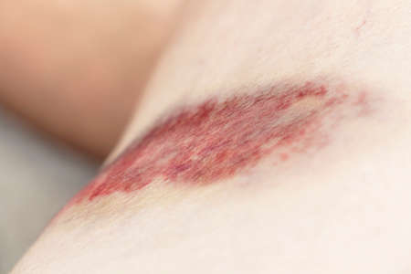 The bruises and wound form scabs on legs. The wound happen during woman Injuries from accident falling down on road.の写真素材