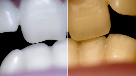 Teeth Before After, Close-up of a mouth with crooked teeth and malocclusion.の写真素材