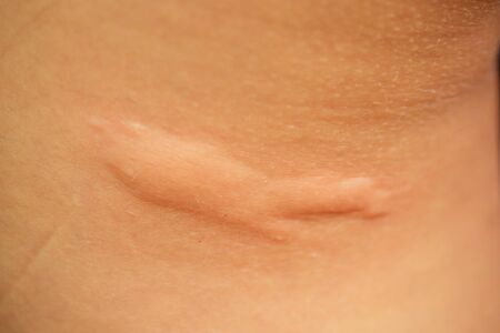 post-acne, scars and red festering pimples on the skin of the face. concept of skin problems and harmonic failureの写真素材