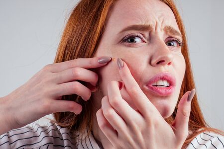 redhead student woman squeezing her pimples, removing pimple from her face white background studio