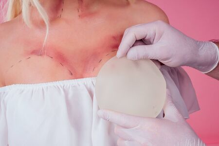 Flawless face of young beautiful blonde long hair patient woman and doctor surgery consulting about breast augmentation mammoplasty,choose new bust gel implant improvement sizeの写真素材