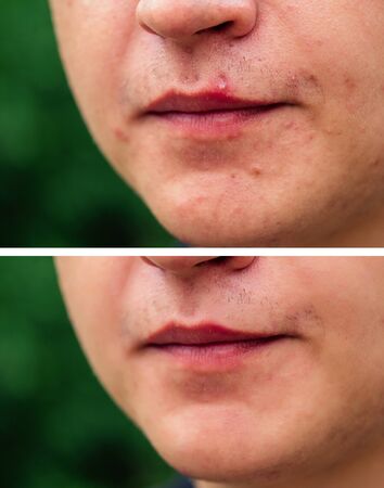 pimples on the face of a man close-upsの写真素材