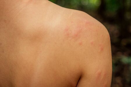 Woman with itching from biting insect in body in tropical jungle forest.