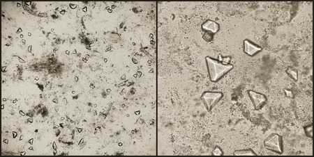 Triple phosphates and amorphous phosphates crystals in alkaline human urine