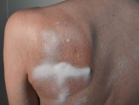 Blistering sunburn treatment on burnt back with medical aerosol medicineの写真素材