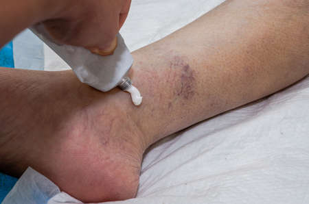 A doctor traumatologist treats a bruise on an injured leg near the knee with a healing ointment in...
