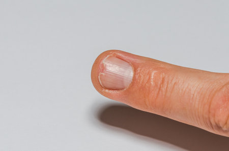 Broken nail on the finger of a manの写真素材
