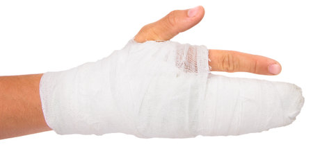 Broken arm in gypsum after fracture isolated. Medical affairの写真素材