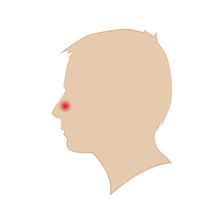 Silhouette of a mans head. Runny nose. Vector.のイラスト素材