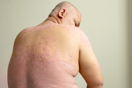 A sick man with psoriasis Looking at yourself is full of traumatic wounds.の写真素材