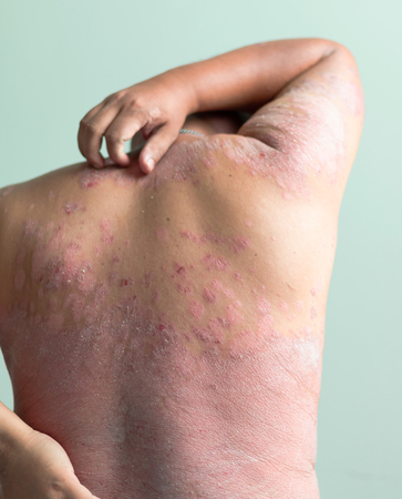 Men use hands to scratch the wound. Diseases caused by abnormalities of the lymph. Psoriasis is a skin disease. Select focus shallow depth of field and blurred backgroundの写真素材