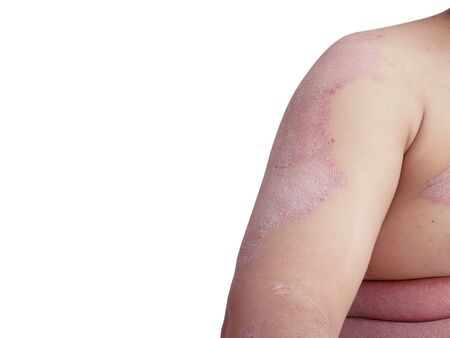 Close up shoulder ulcers on the white background. Diseases caused by abnormalities of the lymph....