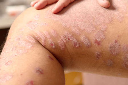 Diseases caused by abnormalities of the lymph. Psoriasis is a skin disease.