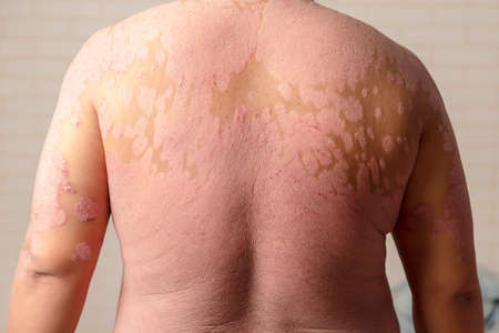 Diseases caused by abnormalities of the lymph. Psoriasis is a skin disease.の写真素材