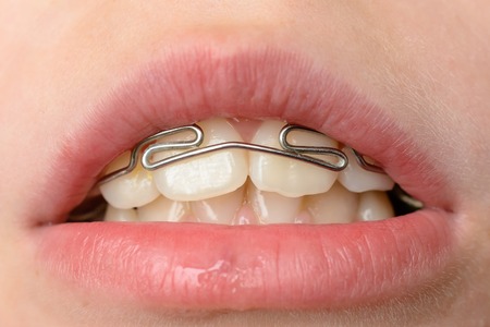 Close-up mouth of crooked teeth with braces Toothbrush in the mouth of the adolescent 2019