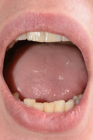 The woman opened her mouth wide, and showed her crooked and rotten teeth close up 2019