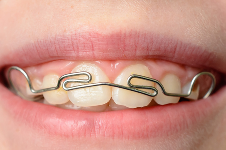 Close-up of a metal plate in the mouth on the teeth of a little boy 2019