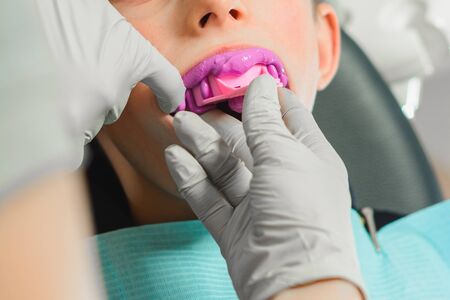 Registration of impressions and bites in a young teenager. Functional modern dental diagnostics 2020