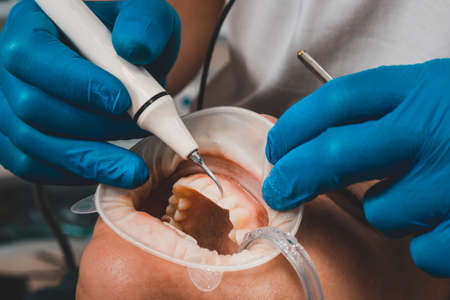 The dentist removes tartar using ultrasound, the patient at the dentist. Retractor for isolation of...