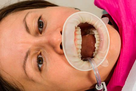 Oral hygiene, a woman at the dentist's office, the use of a retractor while brushing teeth from tartar. 2020の写真素材