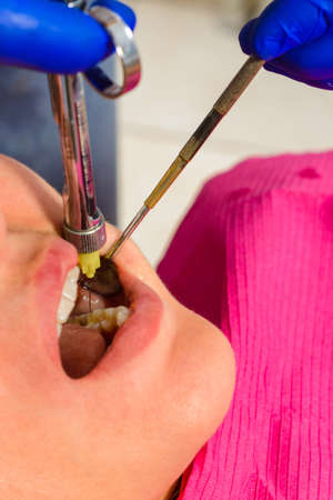 Local anesthesia, anesthesia, injection with a carpule syringe, the dentist injects the patient....
