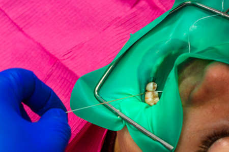 Installation of a cofferdam to the patient, modern dental equipment, treatment in sterile...