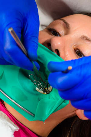 Dental restoration and polymerization of tooth composite materials, the doctor conducts sterile work...