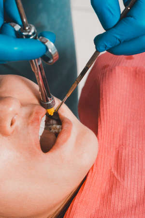 Local anesthesia, dentist carpal syringe injects the patient's gum anesthesia, dental carpule...