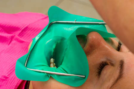 Installation of a cofferdam to the patient, modern dental equipment, treatment in sterile...