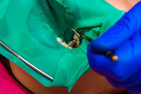 Treatment of posterior tooth, mouth covered with rubber dam, sterile treatment with modern...