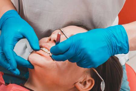After filling, the dentist removes the excess material from the tooth with a copying tracing paper....