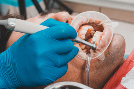 patient removing tartar, the dentist uses ultrasound to remove tartar, dental scaler. 2020の写真素材