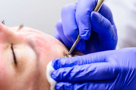 Mechanical facial cleansing, skin cleansing procedure from surface and deep impurities. new